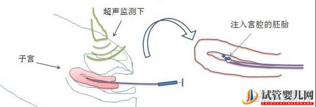 试管移植的具体步骤全解析(图1)