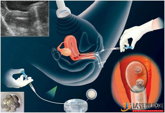 冻胚移植的流程概述_子宫内膜及身体准备非常重要(图4)