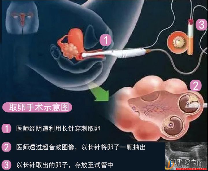 “取卵”手术全过程揭秘(图1)