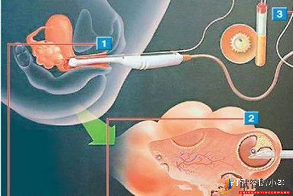 试管婴儿基本流程(图3)