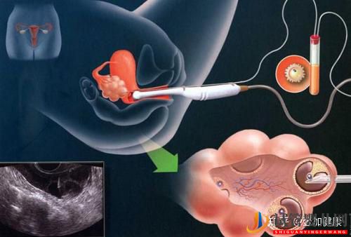 试管婴儿过程中的取卵手术真的很痛吗_看完你就安心了(图1)