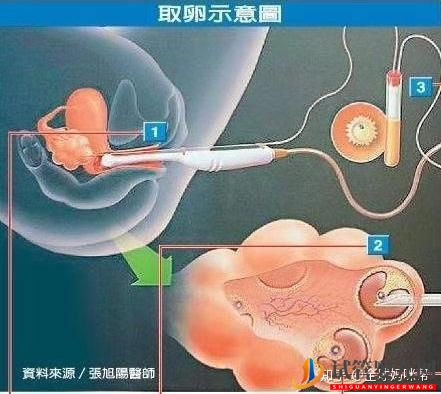 乌海试管婴儿是怎么做的_一分钟带你看懂全过程(图7)