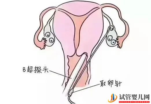 一文读懂试管婴儿全过程(图5)