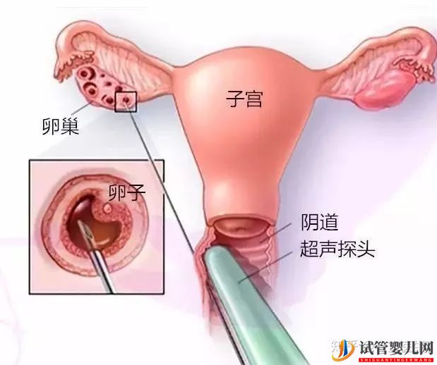 取卵真的特别疼吗(图4)