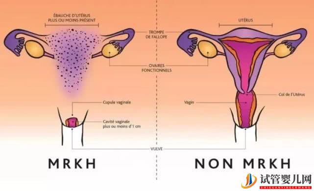 先天无子宫可以做美国试管婴儿吗？(图1)