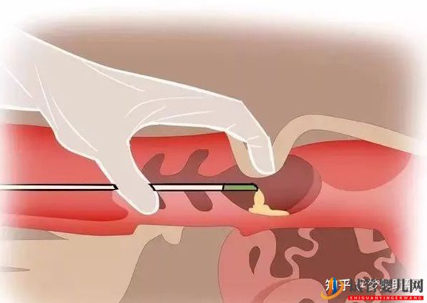 美国试管专家讲解人工授精和试管婴儿的区别(图2)