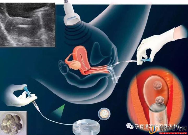 试管婴儿技术,美国vs中国(图3)