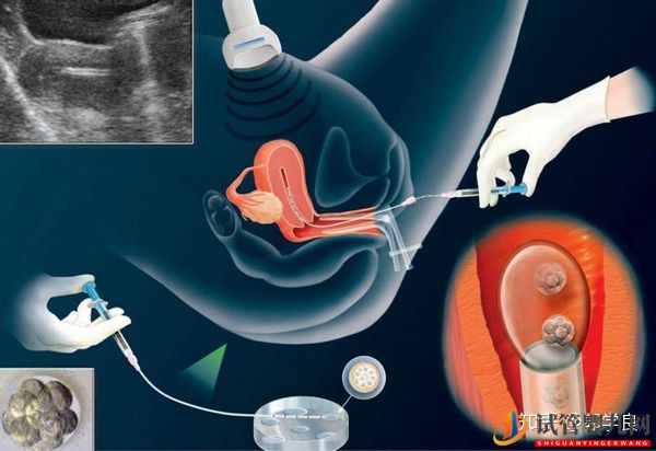美国试管婴儿技术剖析-六个环节操作细节解读(图5)