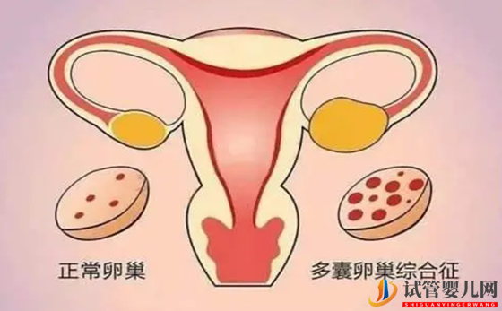 双侧卵巢多囊能怀孕吗 双侧卵巢多囊原因是什么(图2)