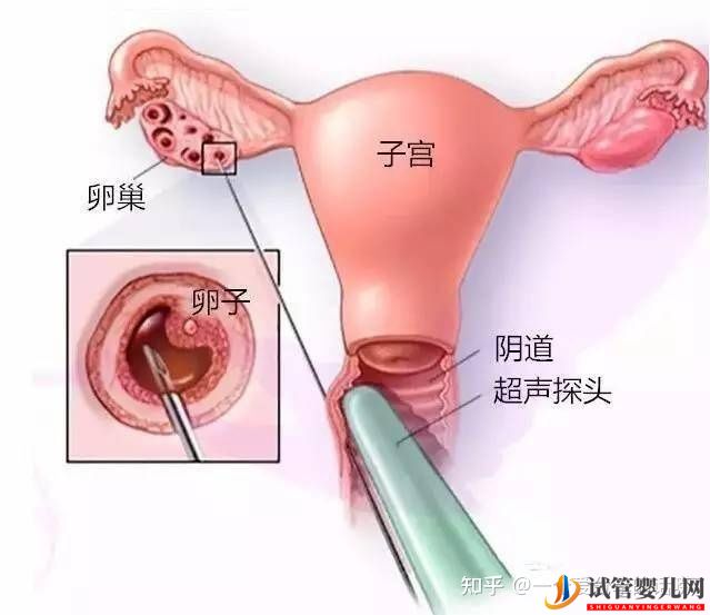 试管的时候,取卵痛吗(图1)