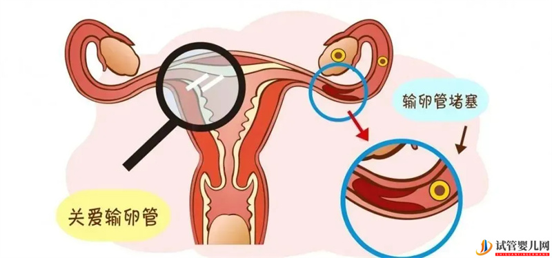 输卵管造影疼吗？做完多久可以要孩子？你想问的这里都有答案！(图1)