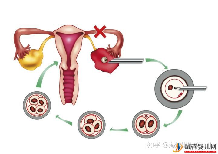 试管婴儿1代、2代、3代、4代哪个最好_真实操作过(图2)