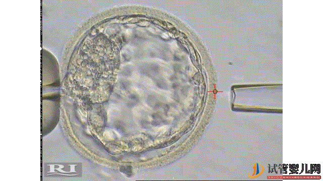 国内外三代试管,技术成熟安全吗(图2)
