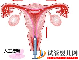 不孕，试管婴儿和人工授精应该选择哪一个？(图4)