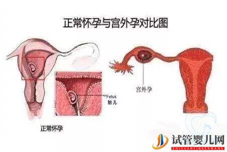 做试管婴儿宫外孕会发生吗？做试管婴儿能不能避免宫外孕(图2)