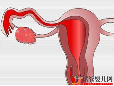 子宫肌瘤做俄罗斯试管婴儿的成功率高吗？(图1)