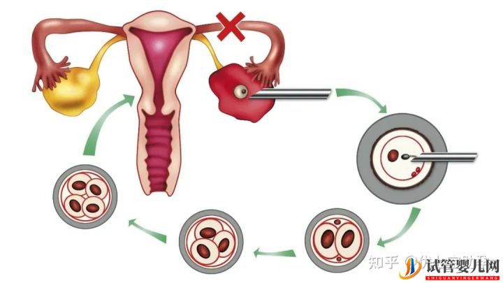 全面解析第三代试管婴儿的科普知识(图11)