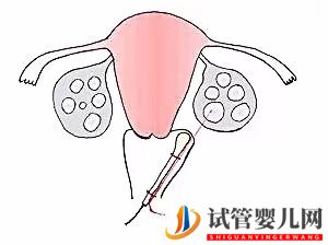 取卵后月经不正常是怎么回事？试管婴儿取卵后多久来月经正常？(图1)