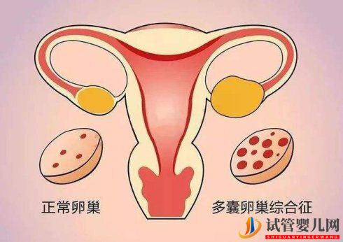 试管取卵后怎么解决卵巢过度刺激综合症(图1)