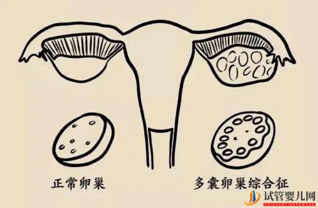 造成多囊卵巢的原因有哪些(图1)