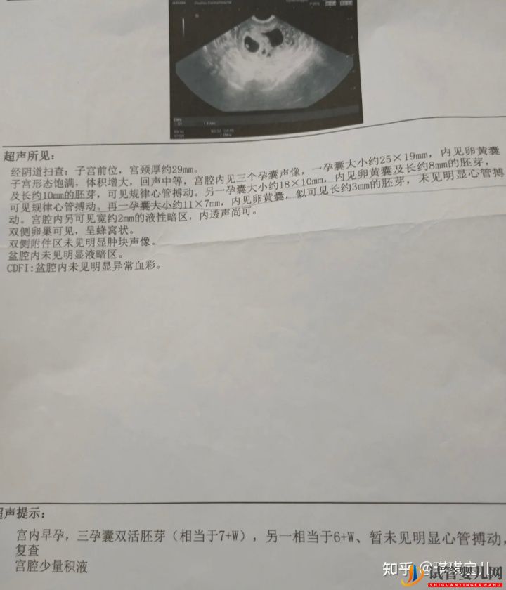 试管一次性成功,喜迎双胎超顺利(图4)