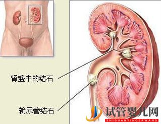 治疗肾结石的费用大概需要多少钱？(图1)