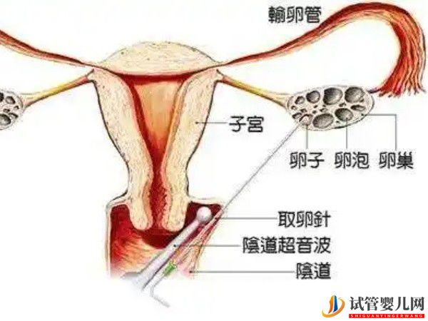 在医院做试管取卵时使用的双腔取卵针有多贵？(图1)