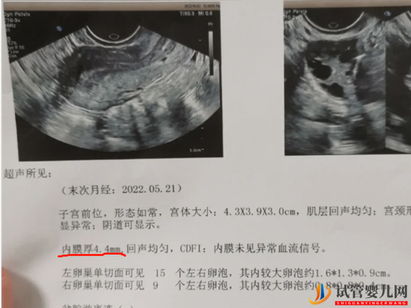 子宫内膜厚4.4mm状态正常也别急！移植最佳厚度还没到(图2)