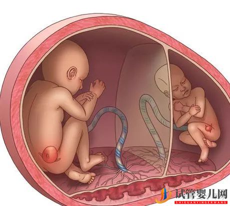 美国试管可以做双胞胎吗风险大不大(图4)