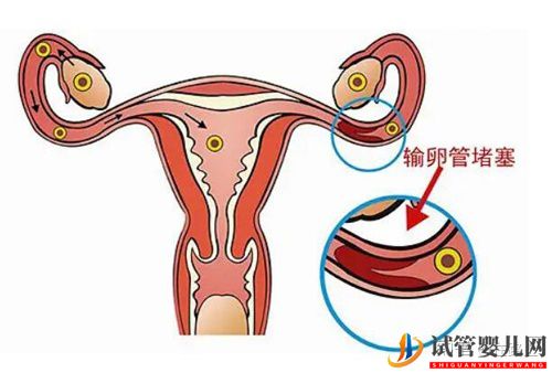 美国试管婴儿如何助孕输卵管性不孕(图1)