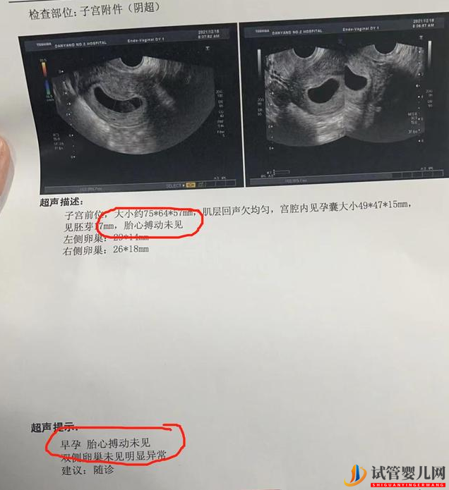 做试管婴儿可以避免胎停吗？(图1)