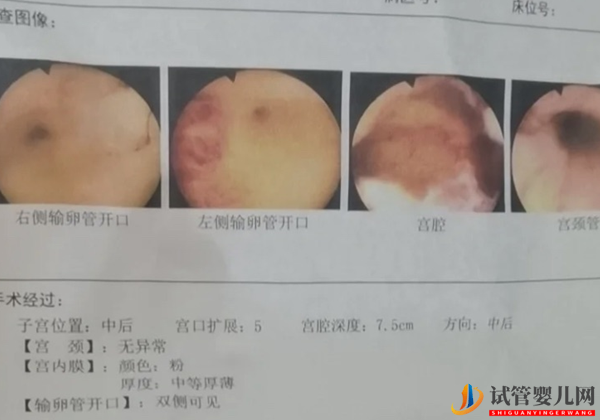 做试管为什么要做宫腔镜检?(图2)