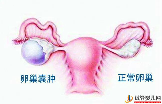 有卵巢囊肿可以做试管婴儿吗？(图1)