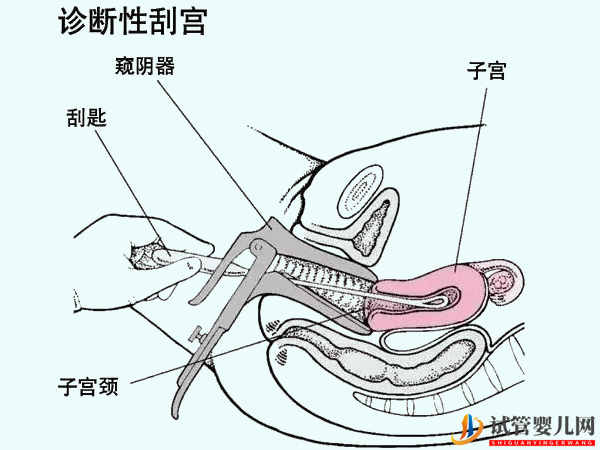 做试管并非人人都要刮宫(图2)