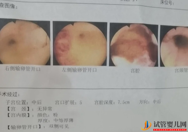 试管术前做宫腔镜的原因(图2)