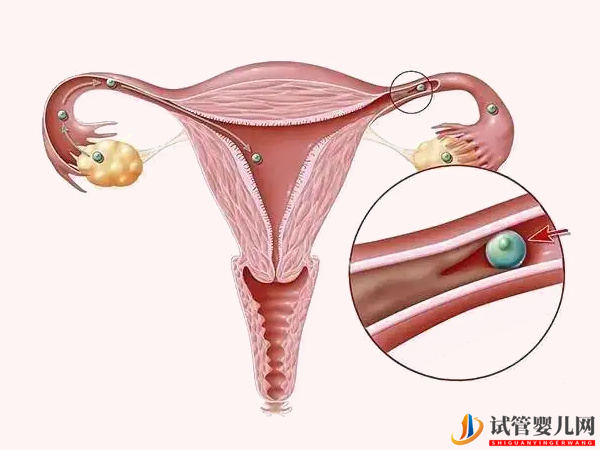 输卵管通而不畅想做试管得先做手术(图1)