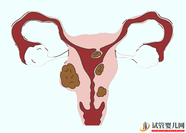 子宫肌瘤做试管成功率不高(图1)