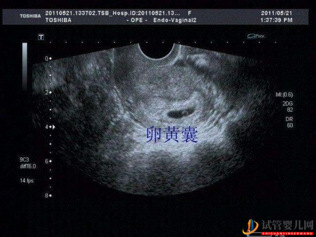 试管婴儿移植胚胎怀孕后卵黄囊大概在多久会出现？(图1)