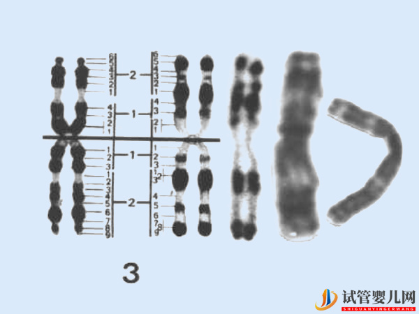 3号染色体异常会怎样 - 基因微缺失、微重复相关病症导航(图1)