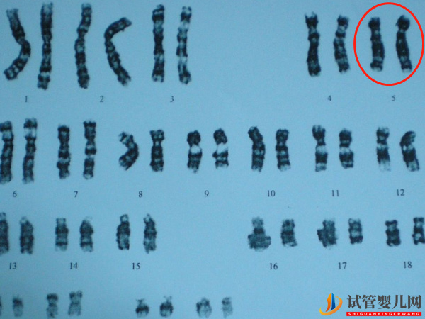 5号染色体决定什么 - 短臂缺失、偏多重复对胎儿的症状表现(图1)