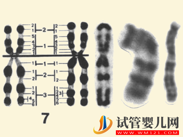 7号染色体异常真不是骗局，出现三体、偏多孩子会有这些疾病(图1)