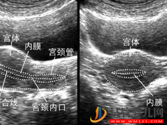 薄型子宫内膜临床表现和诊断标准汇总，及时发现避免不孕(图1)