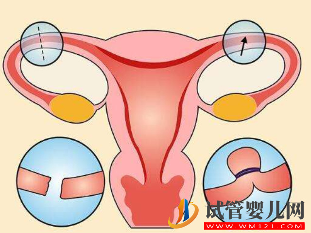 导致女性宫外孕的8大原因，最常见的也许你正在经受！(图3)