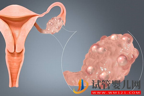 一文说清中医能否三个月治好多囊卵巢，这2种疗法可了解(图1)