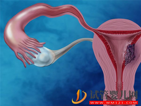 有严重子宫腺肌症没做手术切除做试管成功怀上的案例吗？(图1)