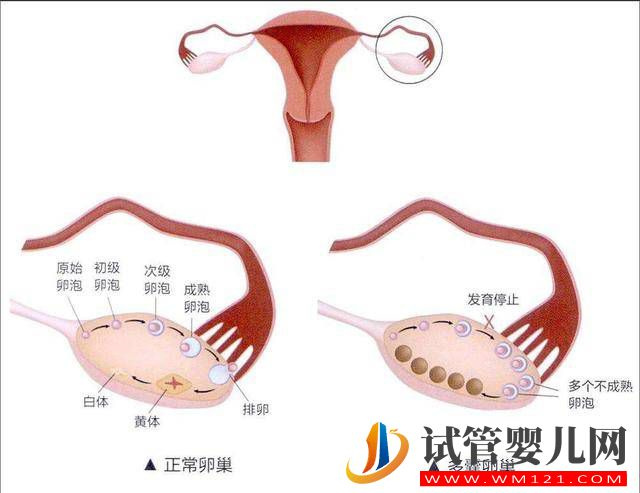 多囊卵巢综合征是怎样的一种疾病？(图1)