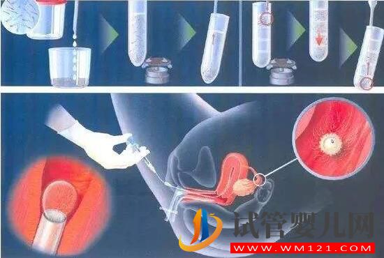 人工授精和试管婴儿详细介绍及对比？(图1)
