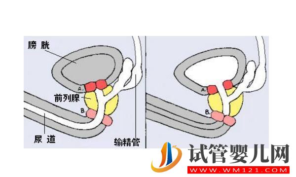 逆行射精可以做试管婴儿吗？(图1)