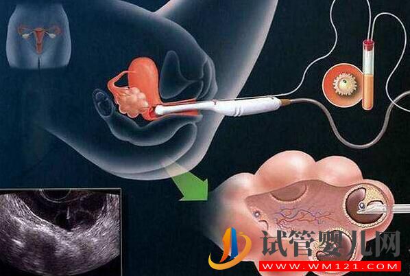 做试管婴儿取多少个卵子合适？(图1)