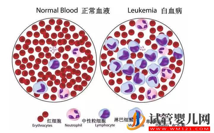 做试管婴儿真的容易得白血病吗？(图1)